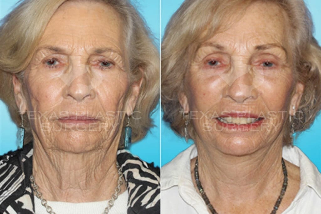 Real Patient results in San Antonio, TX Performed by Texas Plastic Surgery