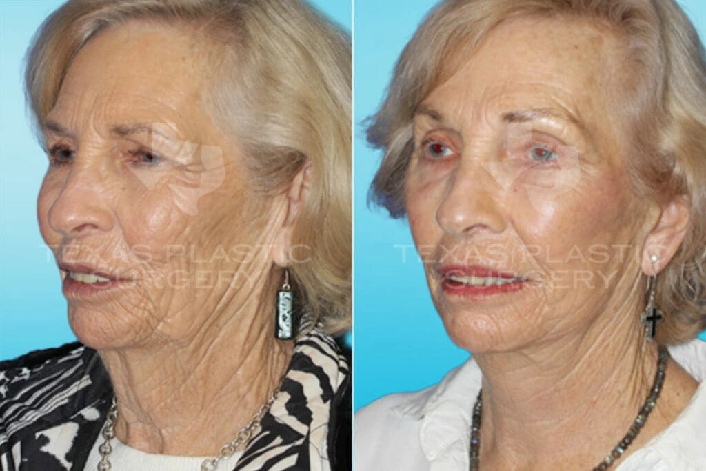 Real Patient results in San Antonio, TX Performed by Texas Plastic Surgery