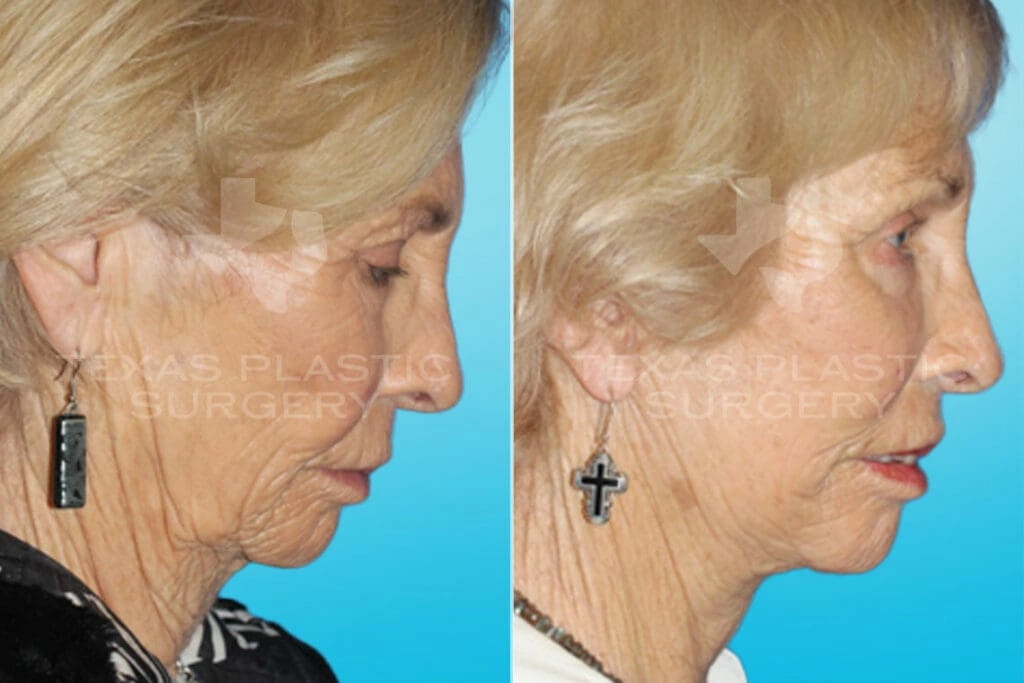 Real Patient results in San Antonio, TX Performed by Texas Plastic Surgery