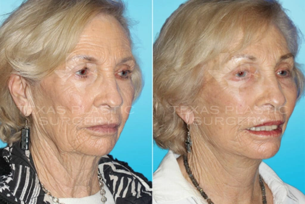 Real Patient results in San Antonio, TX Performed by Texas Plastic Surgery