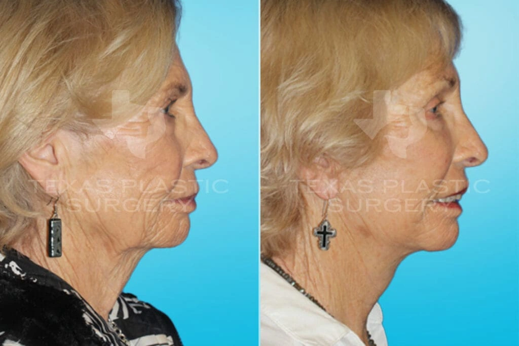 Real Patient results in San Antonio, TX Performed by Texas Plastic Surgery