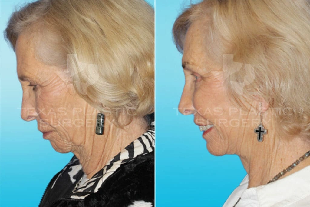 Real Patient results in San Antonio, TX Performed by Texas Plastic Surgery
