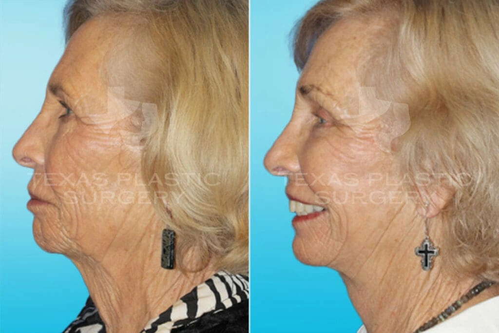 Real Patient results in San Antonio, TX Performed by Texas Plastic Surgery