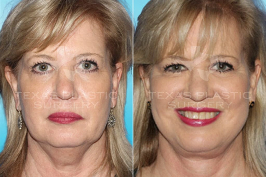 Real Patient results in San Antonio, TX Performed by Texas Plastic Surgery