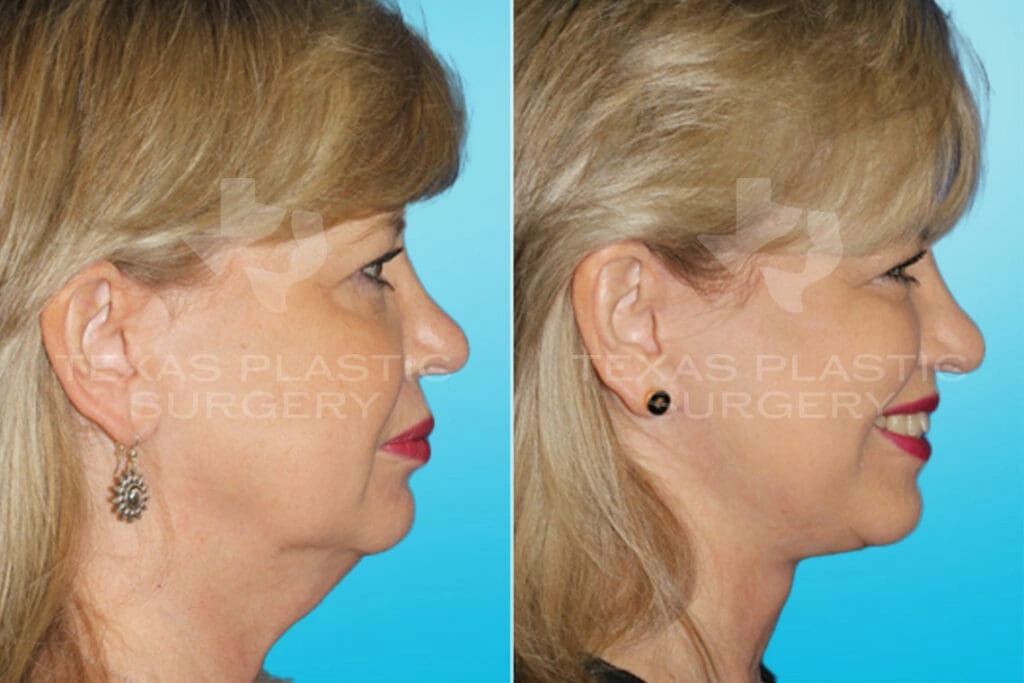 Real Patient results in San Antonio, TX Performed by Texas Plastic Surgery