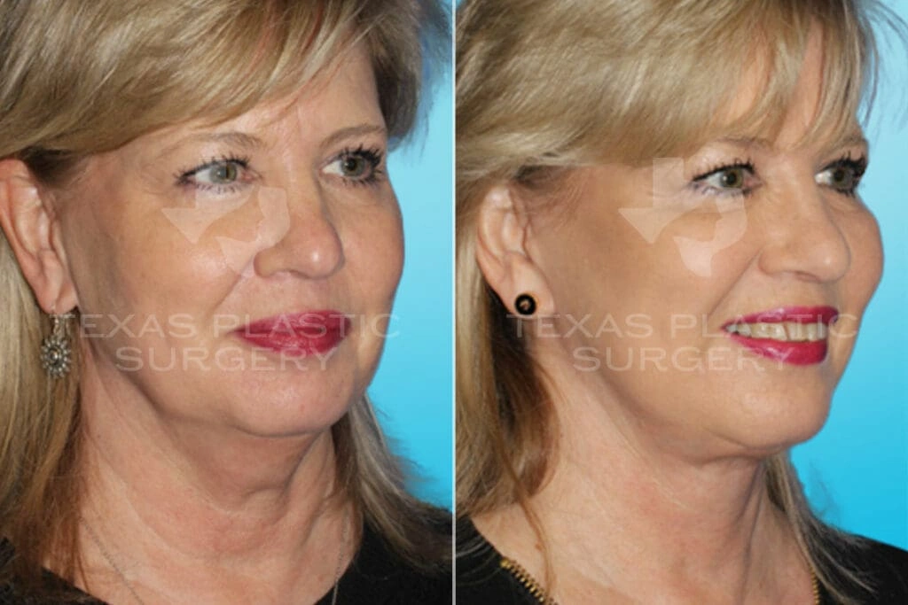 Real Patient results in San Antonio, TX Performed by Texas Plastic Surgery