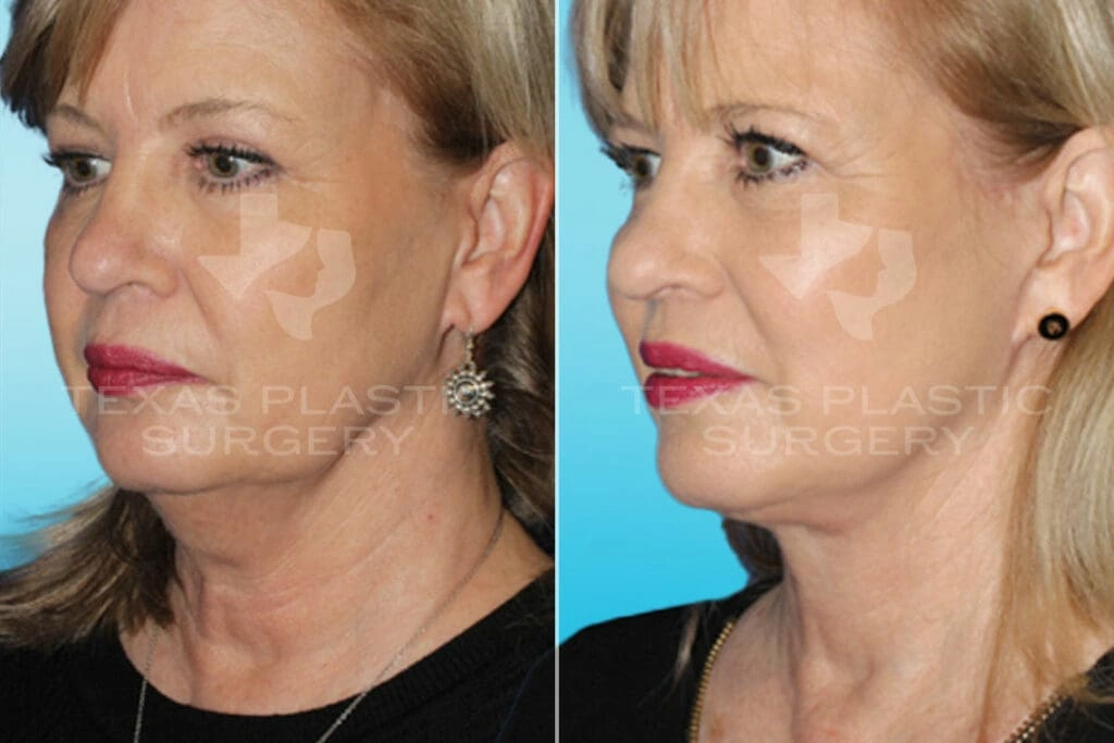 Real Patient results in San Antonio, TX Performed by Texas Plastic Surgery