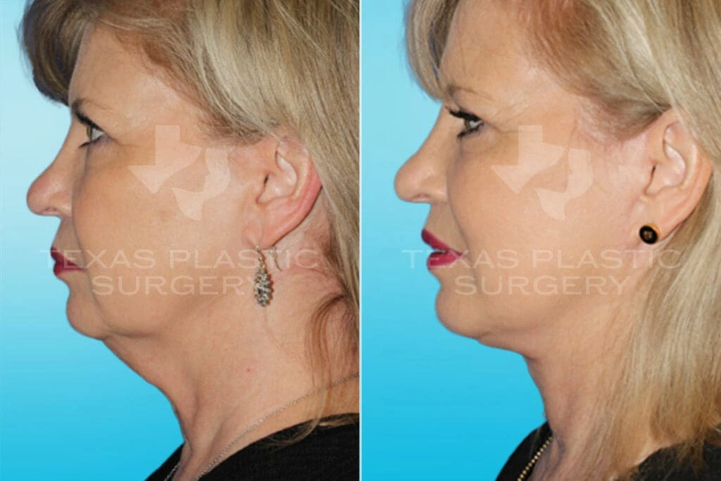 Real Patient results in San Antonio, TX Performed by Texas Plastic Surgery