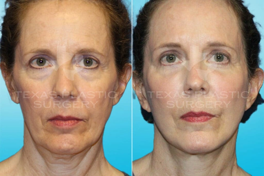 Real Patient results in San Antonio, TX Performed by Texas Plastic Surgery