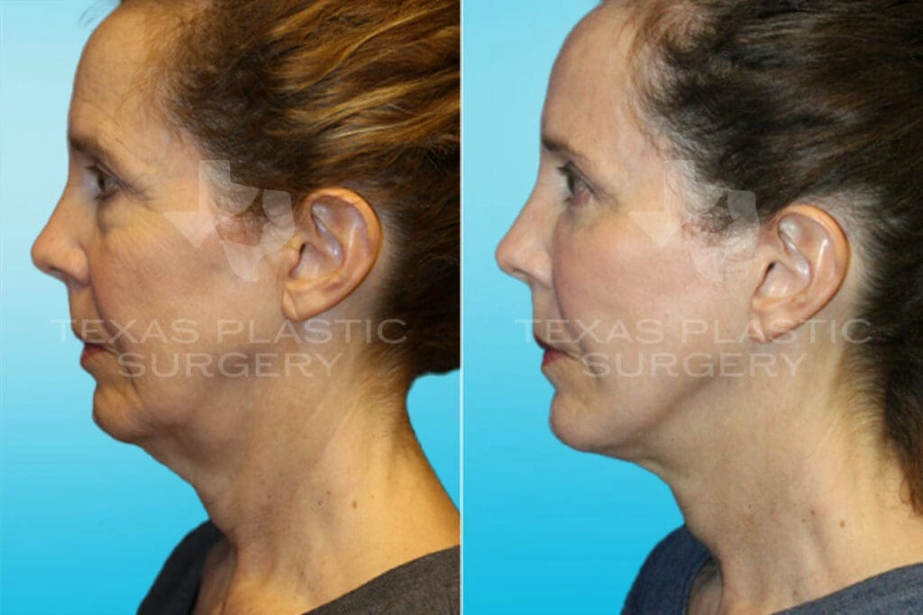 Real Patient results in San Antonio, TX Performed by Texas Plastic Surgery