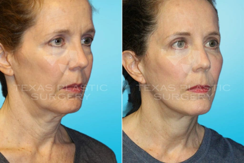 Real Patient results in San Antonio, TX Performed by Texas Plastic Surgery