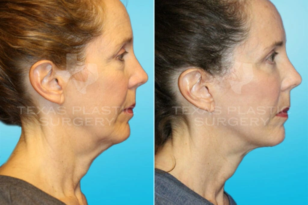 Real Patient results in San Antonio, TX Performed by Texas Plastic Surgery