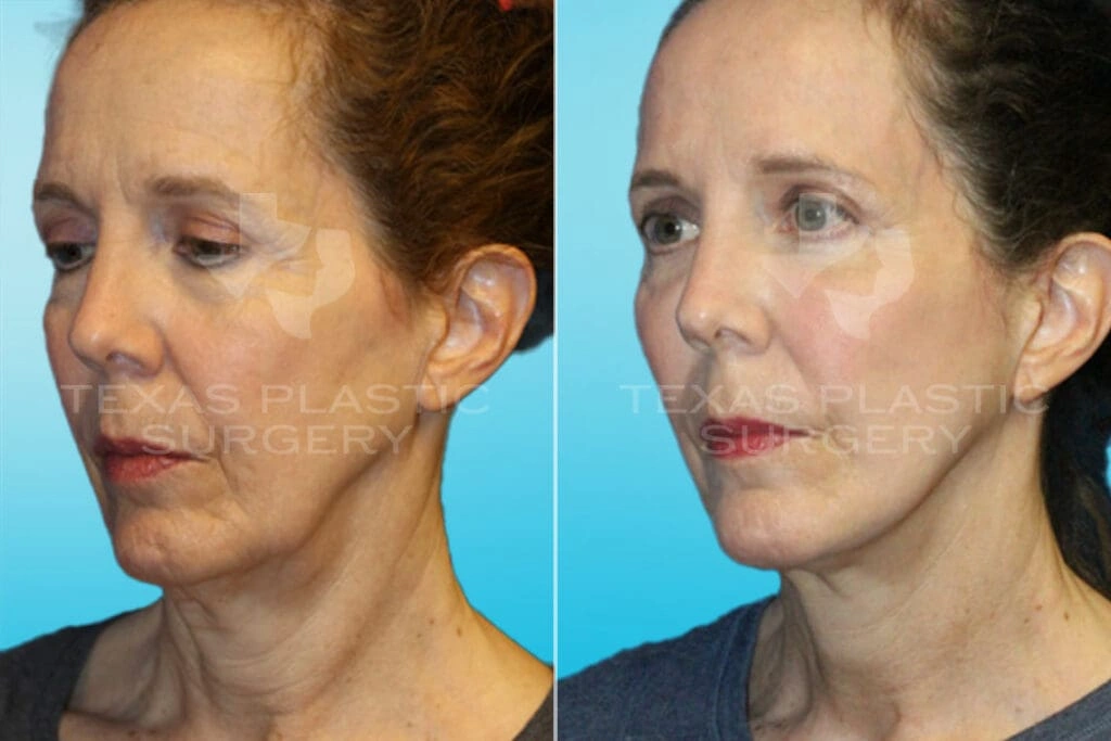 Real Patient results in San Antonio, TX Performed by Texas Plastic Surgery