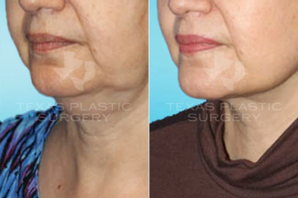 Real Patient results in San Antonio, TX Performed by Texas Plastic Surgery