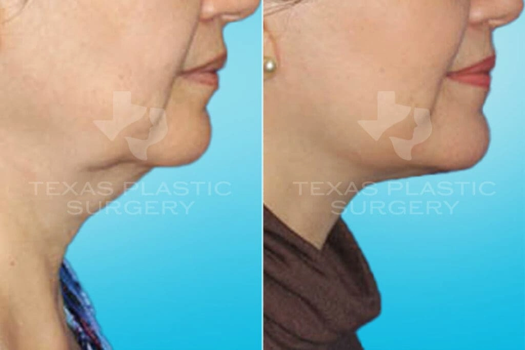 Real Patient results in San Antonio, TX Performed by Texas Plastic Surgery