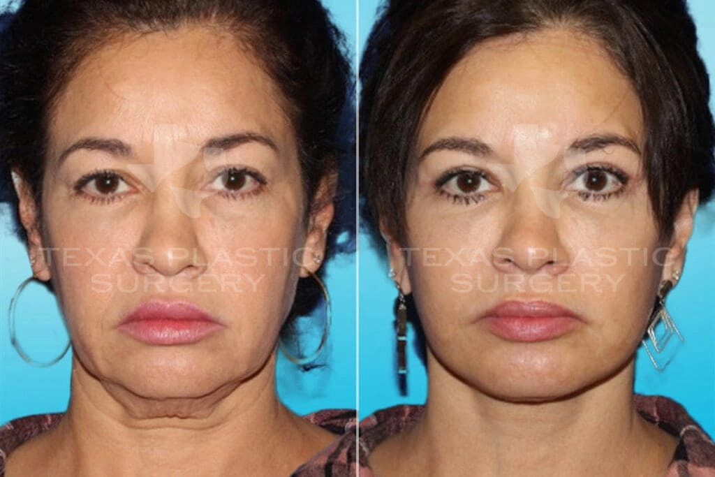 Real Patient results in San Antonio, TX Performed by Texas Plastic Surgery