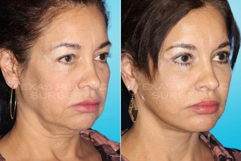 Real Patient results in San Antonio, TX Performed by Texas Plastic Surgery