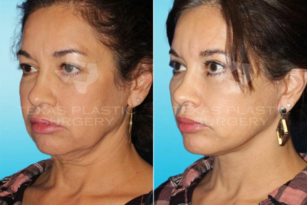 Real Patient results in San Antonio, TX Performed by Texas Plastic Surgery