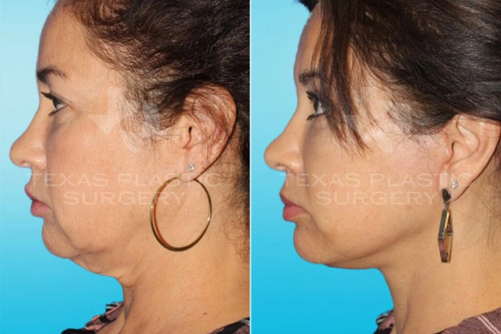 Real Patient results in San Antonio, TX Performed by Texas Plastic Surgery