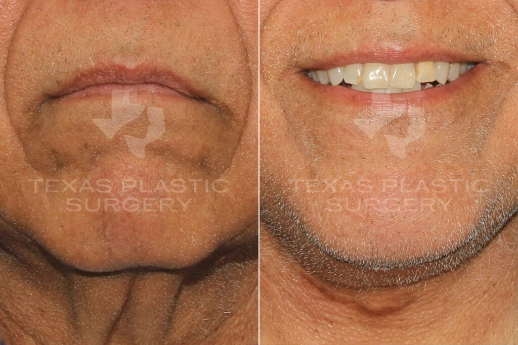Real Patient results in San Antonio, TX Performed by Texas Plastic Surgery