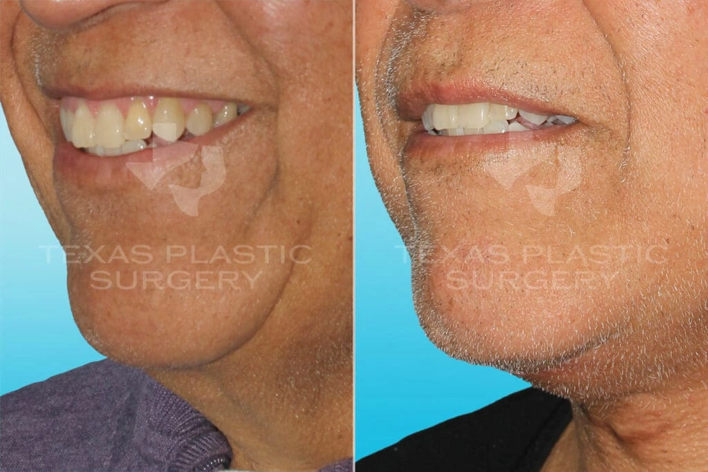 Real Patient results in San Antonio, TX Performed by Texas Plastic Surgery