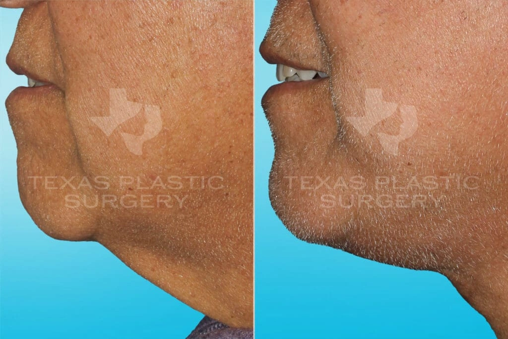Real Patient results in San Antonio, TX Performed by Texas Plastic Surgery