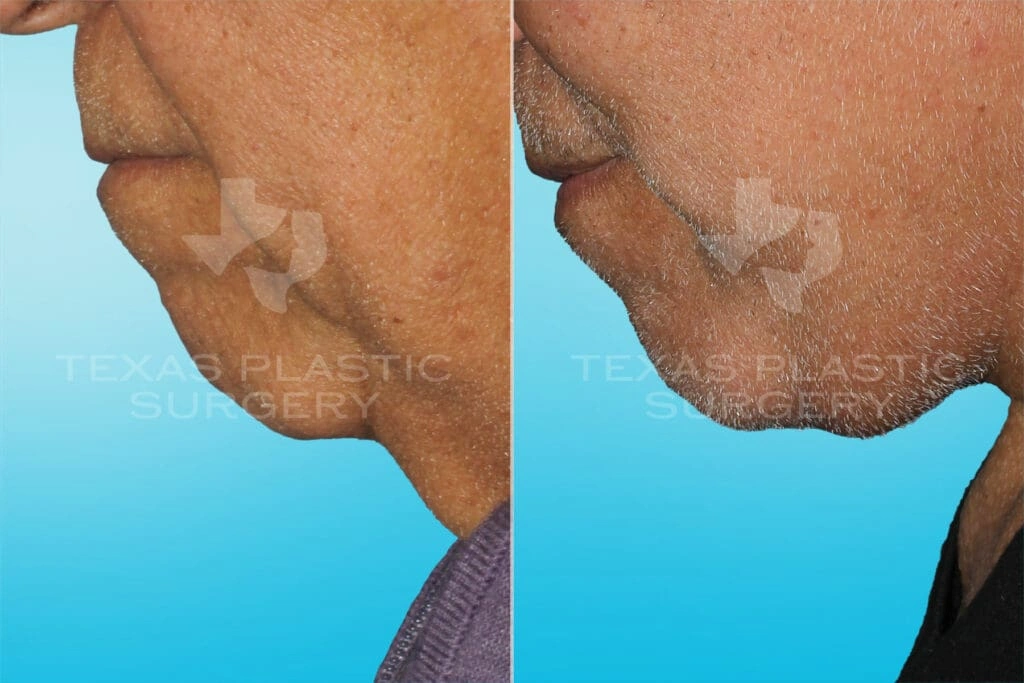 Real Patient results in San Antonio, TX Performed by Texas Plastic Surgery