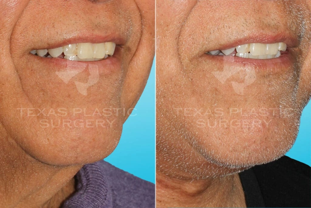 Real Patient results in San Antonio, TX Performed by Texas Plastic Surgery