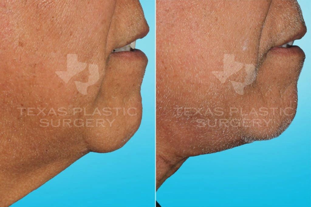 Real Patient results in San Antonio, TX Performed by Texas Plastic Surgery