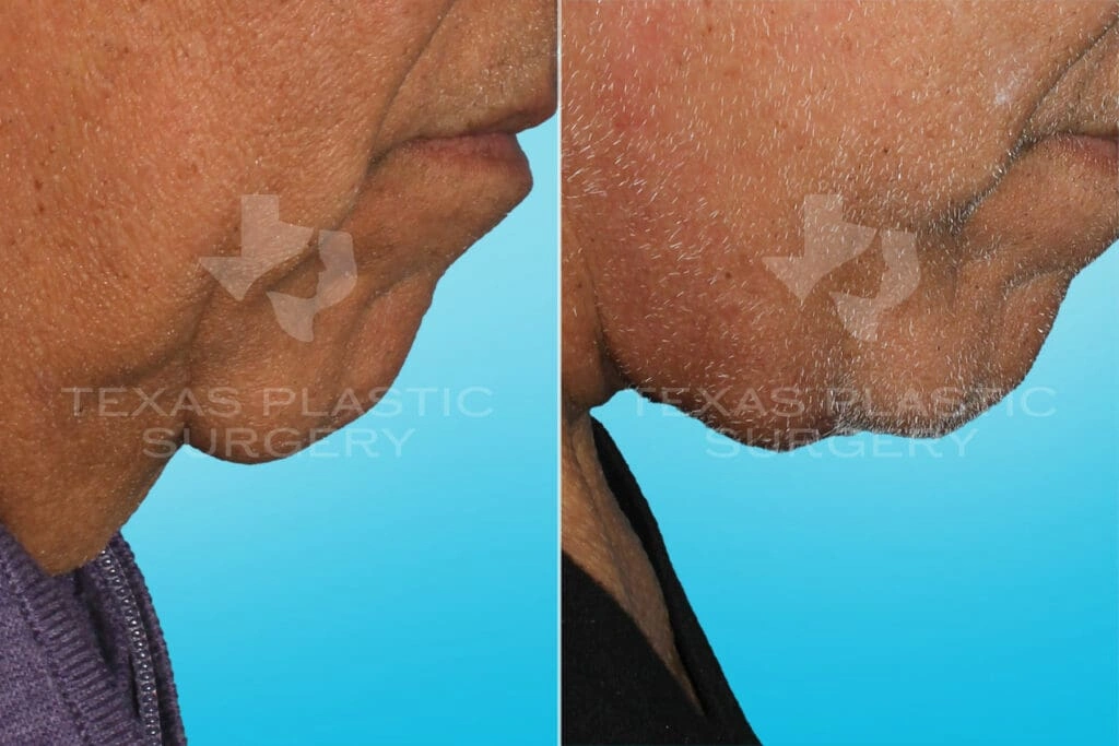 Real Patient results in San Antonio, TX Performed by Texas Plastic Surgery