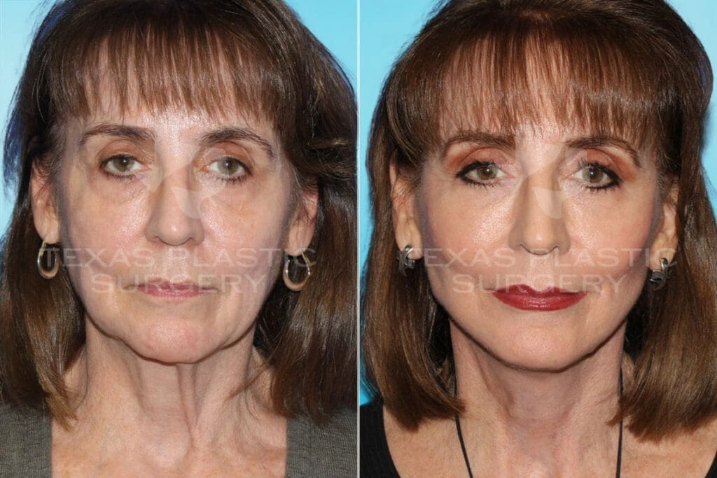 Real Patient results in San Antonio, TX Performed by Texas Plastic Surgery