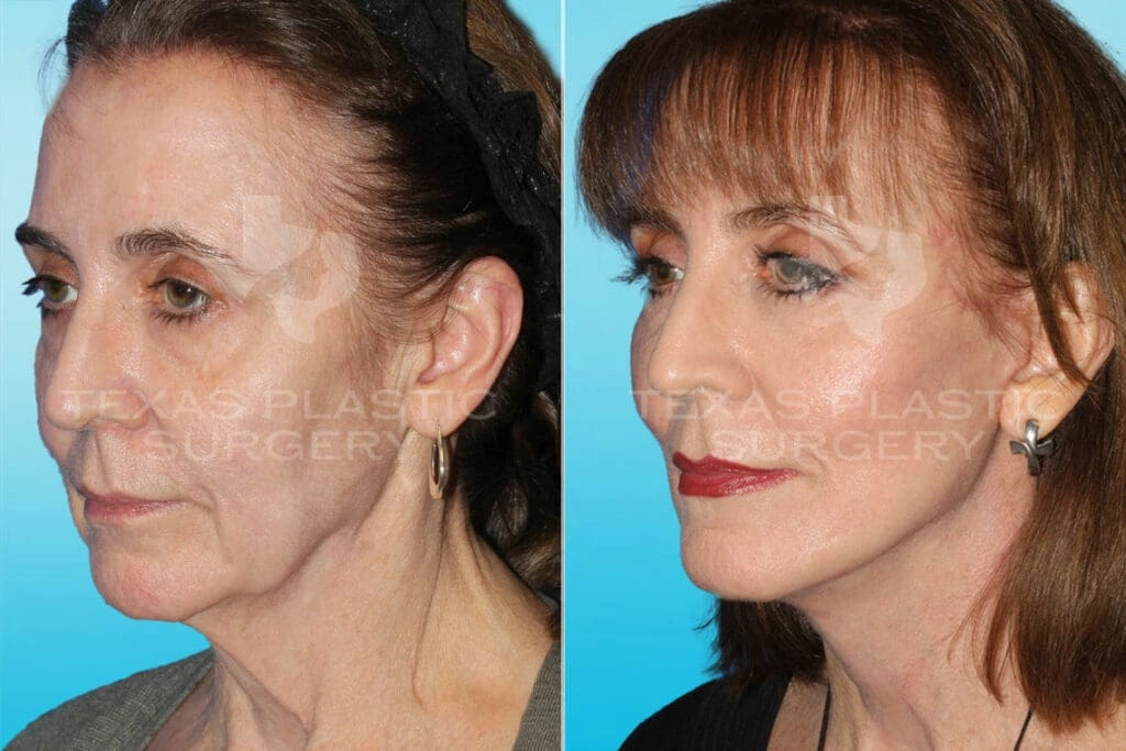 Real Patient results in San Antonio, TX Performed by Texas Plastic Surgery