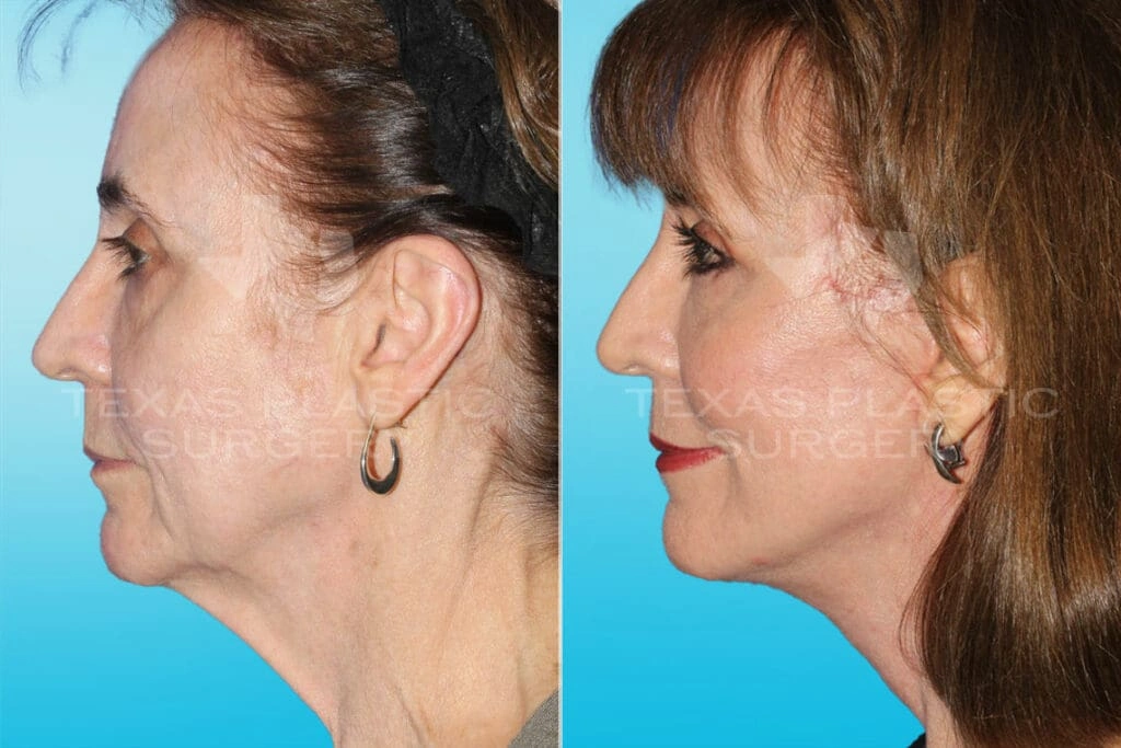 Real Patient results in San Antonio, TX Performed by Texas Plastic Surgery