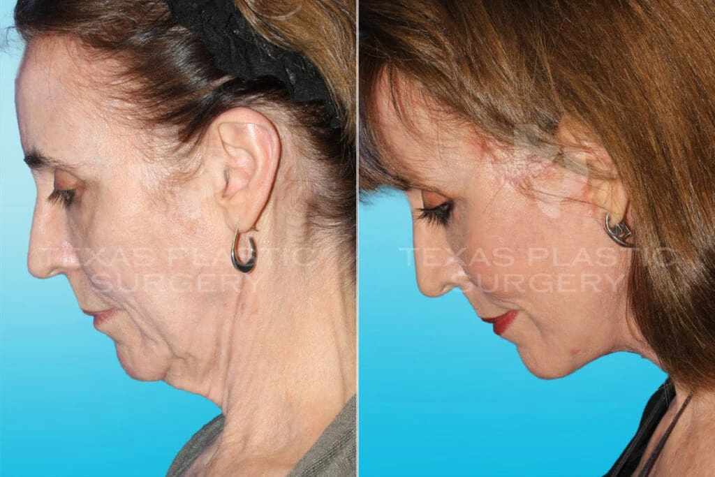 Real Patient results in San Antonio, TX Performed by Texas Plastic Surgery