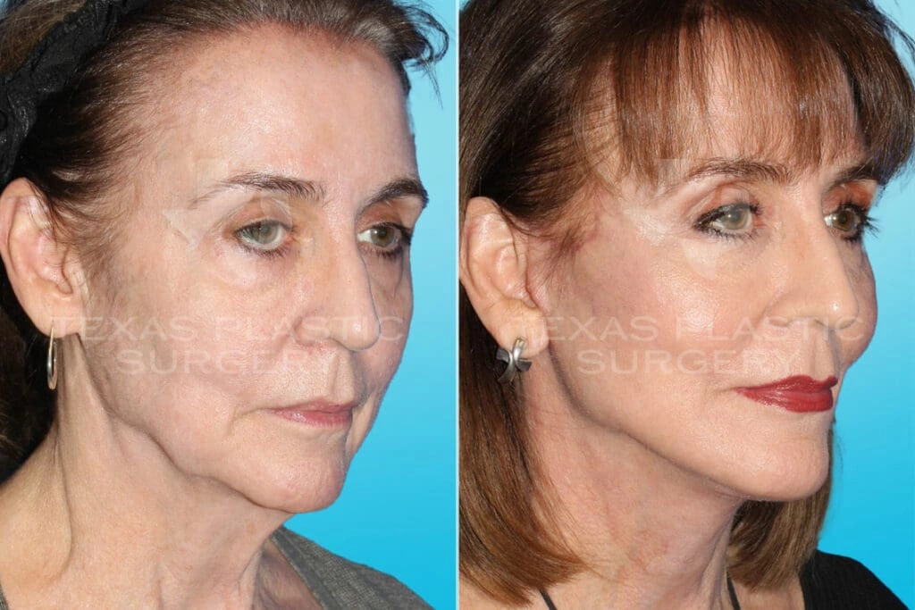 Real Patient results in San Antonio, TX Performed by Texas Plastic Surgery
