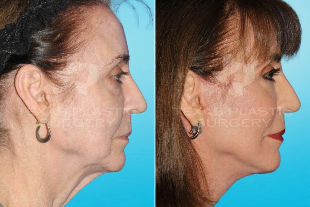 Real Patient results in San Antonio, TX Performed by Texas Plastic Surgery