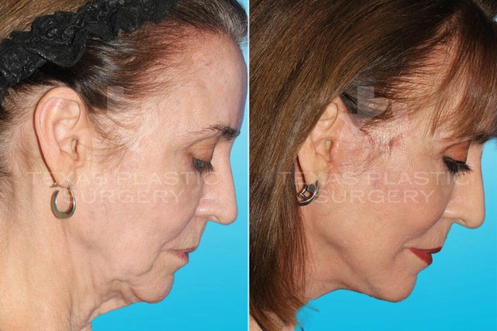 Real Patient results in San Antonio, TX Performed by Texas Plastic Surgery