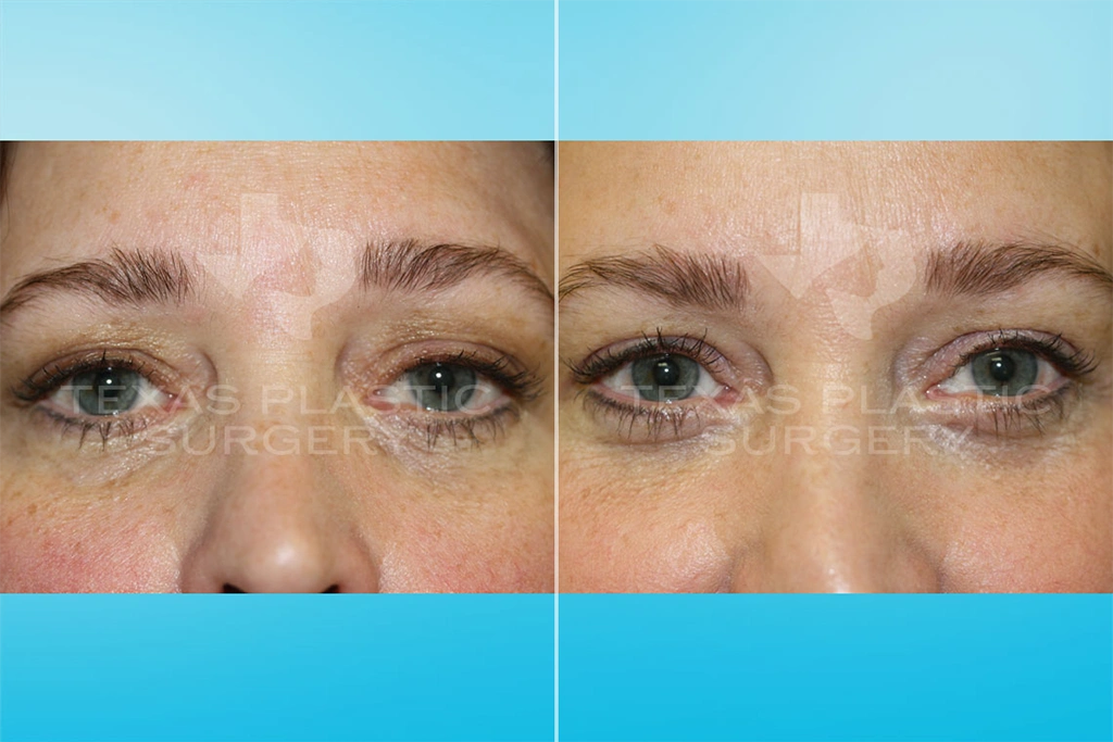 Real Patient results in San Antonio, TX Performed by Texas Plastic Surgery