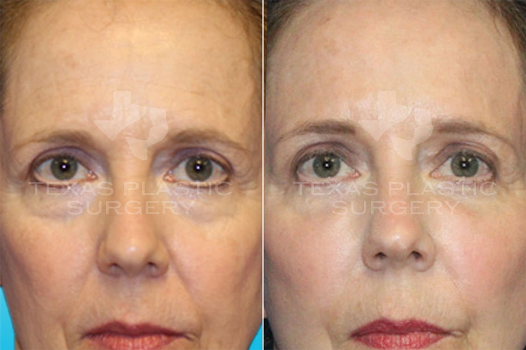 Real Patient results in San Antonio, TX Performed by Texas Plastic Surgery