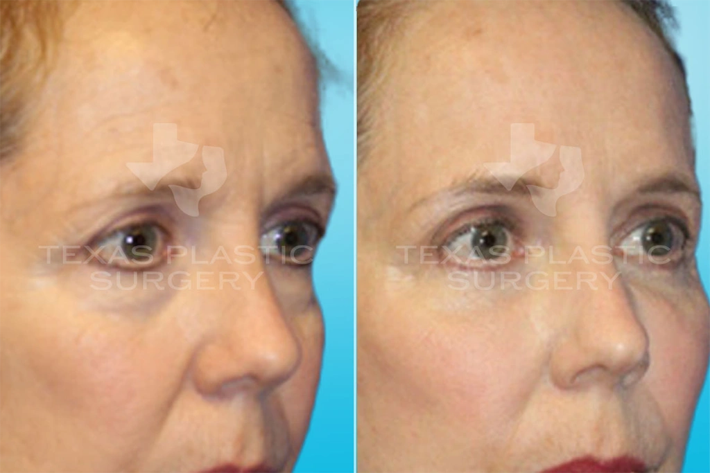 Real Patient results in San Antonio, TX Performed by Texas Plastic Surgery