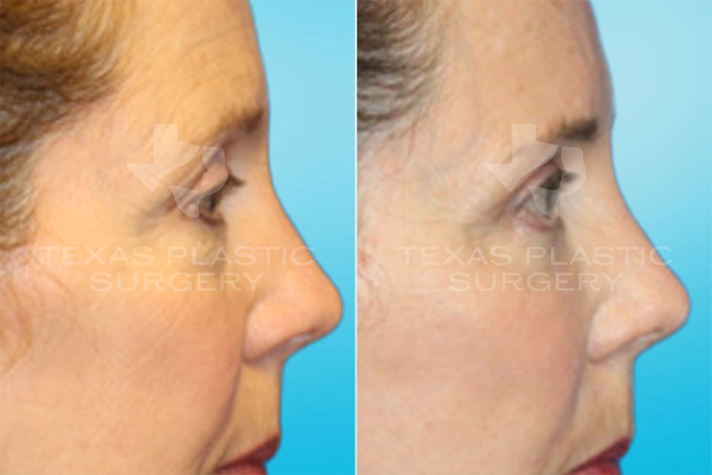 Real Patient results in San Antonio, TX Performed by Texas Plastic Surgery
