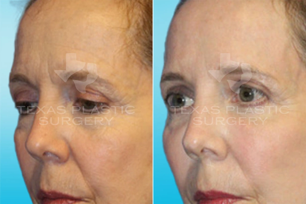 Real Patient results in San Antonio, TX Performed by Texas Plastic Surgery
