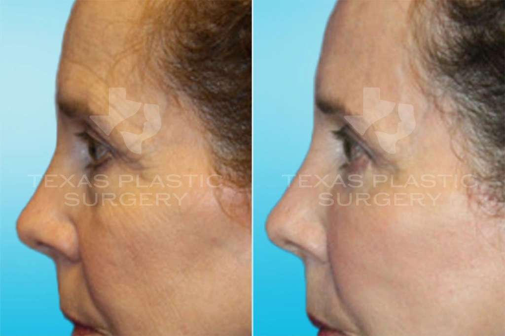 Real Patient results in San Antonio, TX Performed by Texas Plastic Surgery