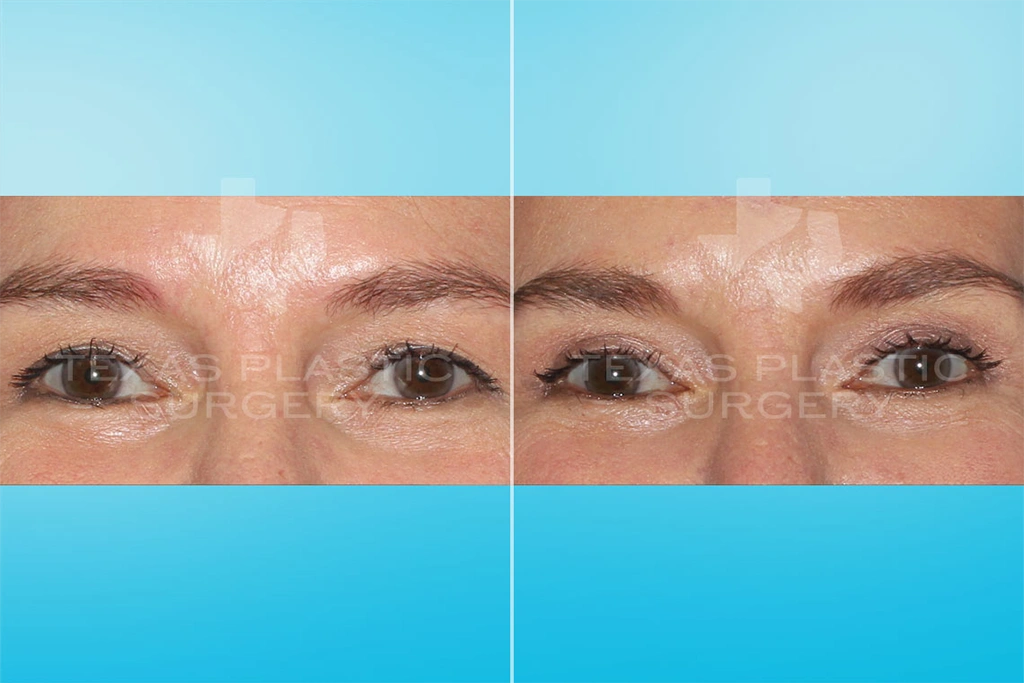 Real Patient results in San Antonio, TX Performed by Texas Plastic Surgery