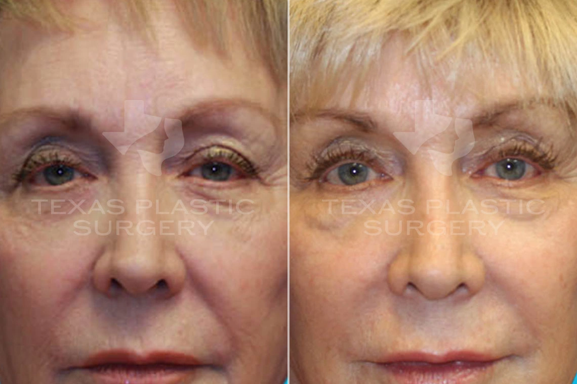 Real Patient results in San Antonio, TX Performed by Texas Plastic Surgery