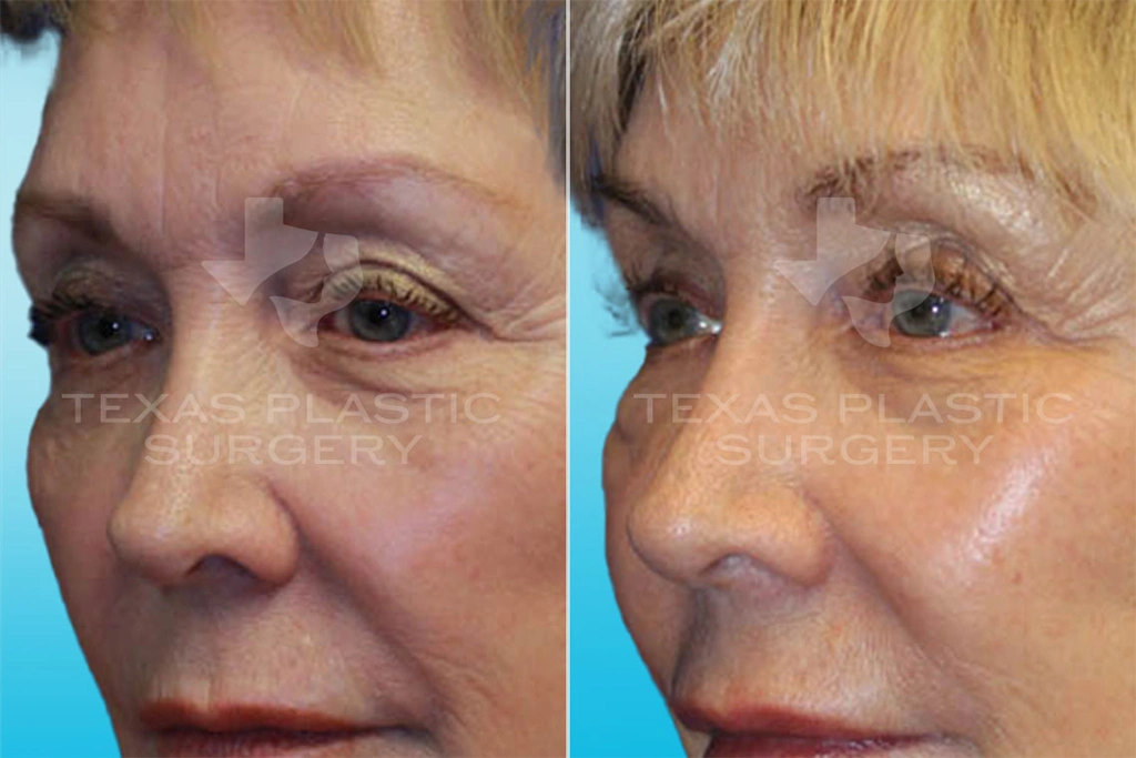 Real Patient results in San Antonio, TX Performed by Texas Plastic Surgery