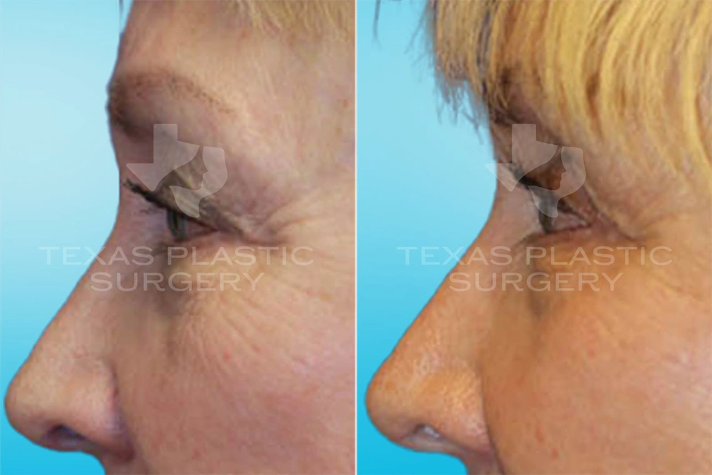 Real Patient results in San Antonio, TX Performed by Texas Plastic Surgery