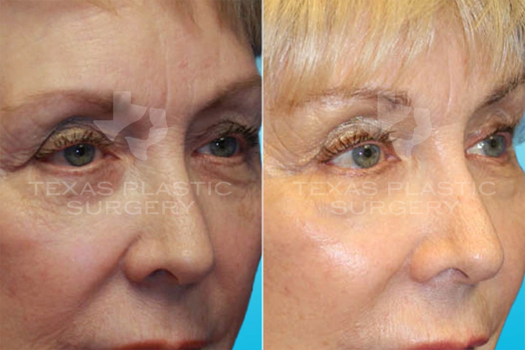 Real Patient results in San Antonio, TX Performed by Texas Plastic Surgery