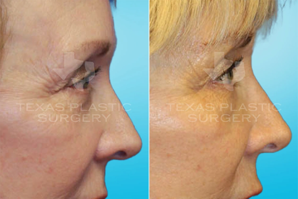 Real Patient results in San Antonio, TX Performed by Texas Plastic Surgery