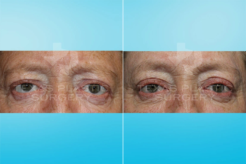 Real Patient results in San Antonio, TX Performed by Texas Plastic Surgery